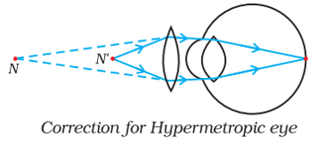 correction for hypermetropia