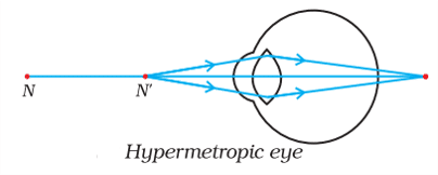 hypermetropia