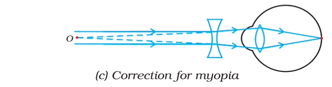 correction for myopia