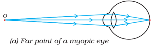 far point of a myopic eye