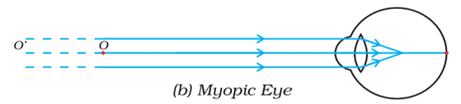 myopic eye