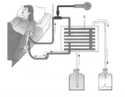 hemodialysis