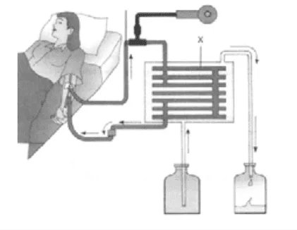 hemodialysis