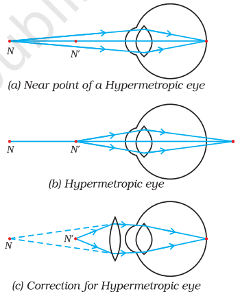 hypermetropia problem and correction class 10 science